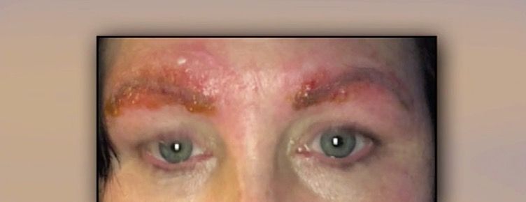 A Discount Microblading Session Gave This Woman a Horrifying Infection—In Her Eyebrows A Discount Microblading Session Gave This Woman a Horrifying Infection—In Her Eyebrows