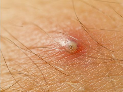 Ingrown Hairs How To Spot And Remove Them