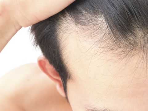 The Surprising Benefit of Hair Transplants