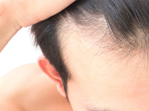 The Surprising Benefit of Hair Transplants The Surprising Benefit of Hair Transplants