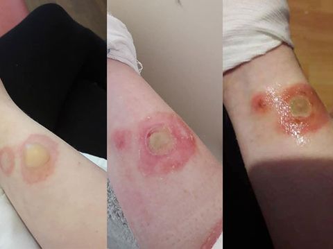 Teen left second-degree burns from 'Deodorant