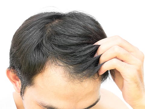 Can Eggs Stop Baldness? These Dermatologists Say Yes Can Eggs Stop Baldness? These Dermatologists Say Yes