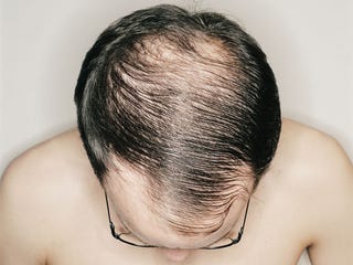 6 ways to slow down hair loss