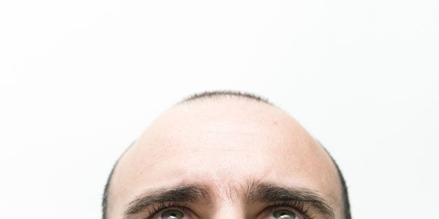 How To Reverse Baldness