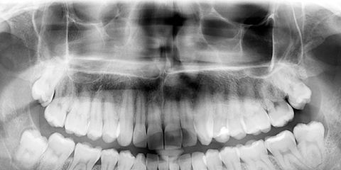 Radiography, X-ray, Jaw, Tooth, Mouth, Organ, Medical radiography, Radiology, Medical, Smile, 