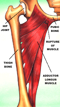 Bodyworks: Adductor Injuries