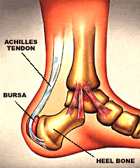 Achilles Bursitis (bursită retrocalcanală)