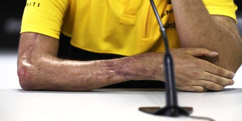 Robert Kubica nearly lost his right forearm in a 2011 rally incident.