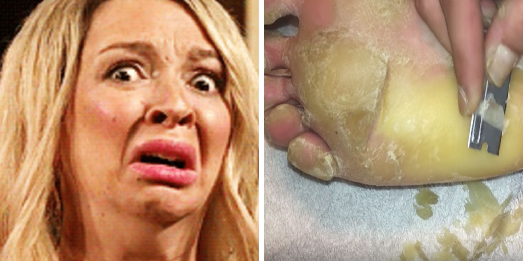 Watch This Guy Remove A Foot Callus With A Razor Blade —  Channel  Devoted To Removing Calluses