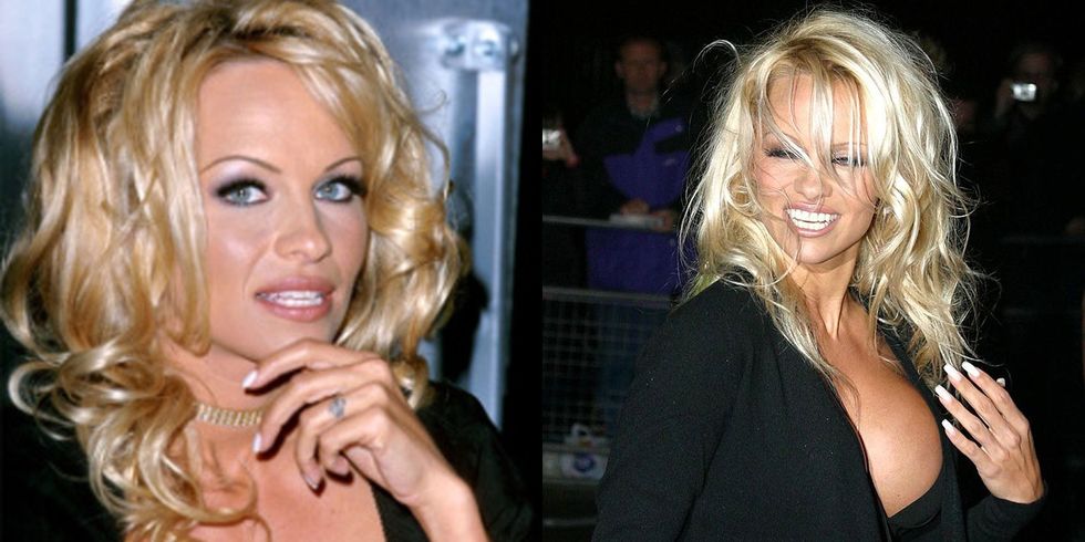 <p>Pamela Anderson ha eliminato il tatuaggio anello per Tommy Lee dopo il divorzio nel 1998. Un'altra dimostrazione del fatto che bisognerebbe sempre scegliere un gioiello come anello.&nbsp;</p>