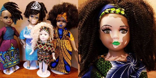 bambole personalizzate bellezza vitiligine