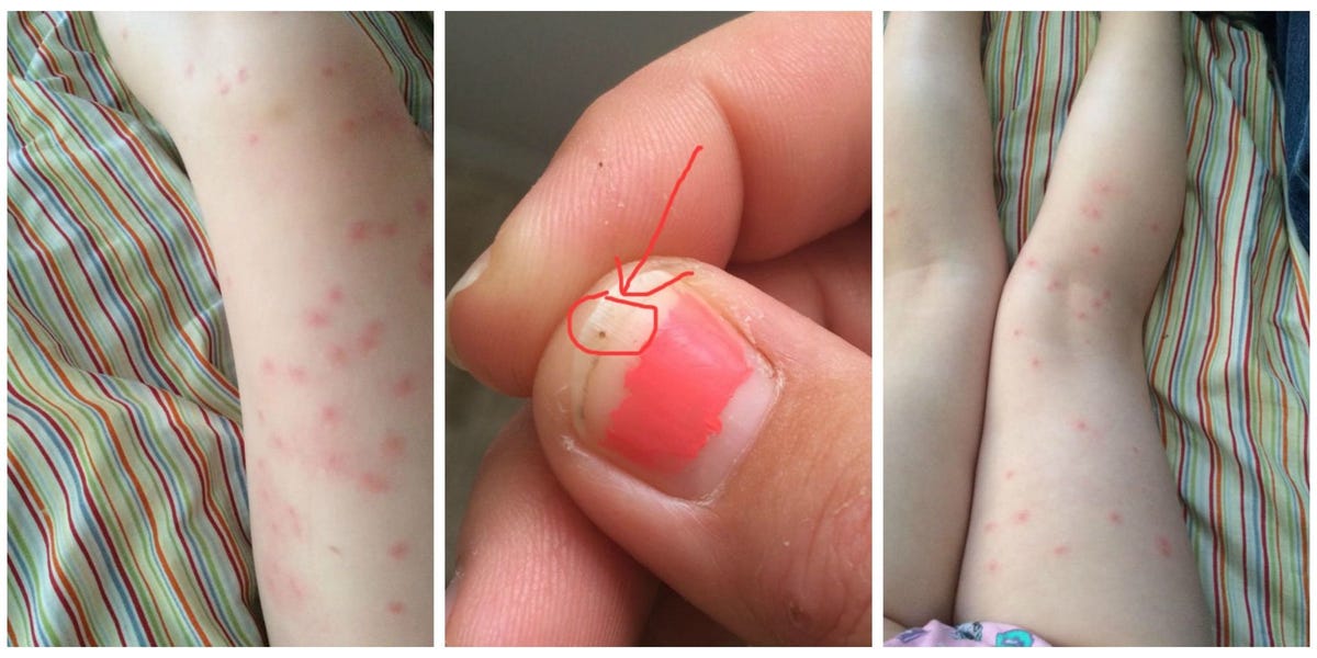 Why All Families Need to Be on the Lookout for "Seed Ticks" This Summer