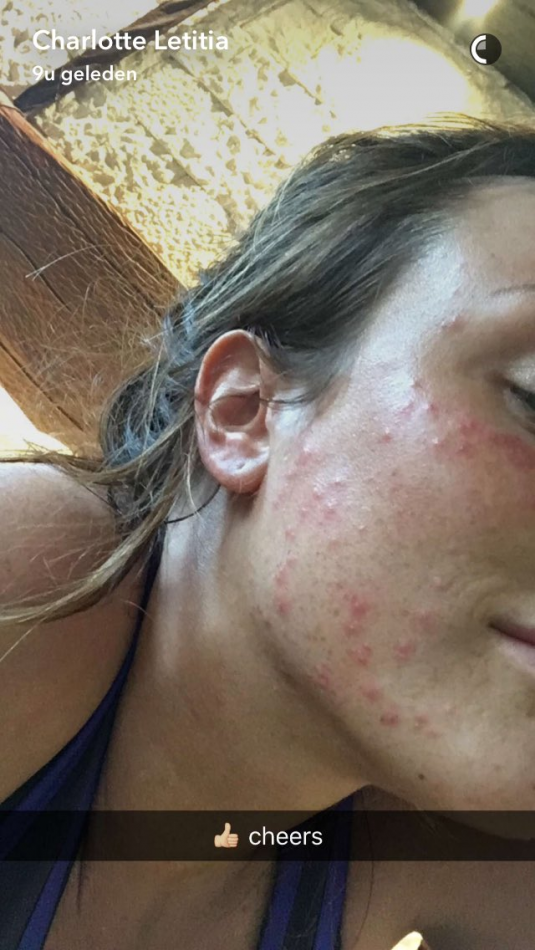 Charlotte Crosby eczeem acne allergie