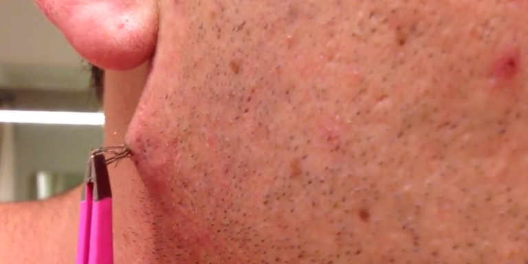 Watch This Man Pull Out The World S Longest Ingrown Hair And Try Not To Barf Forever