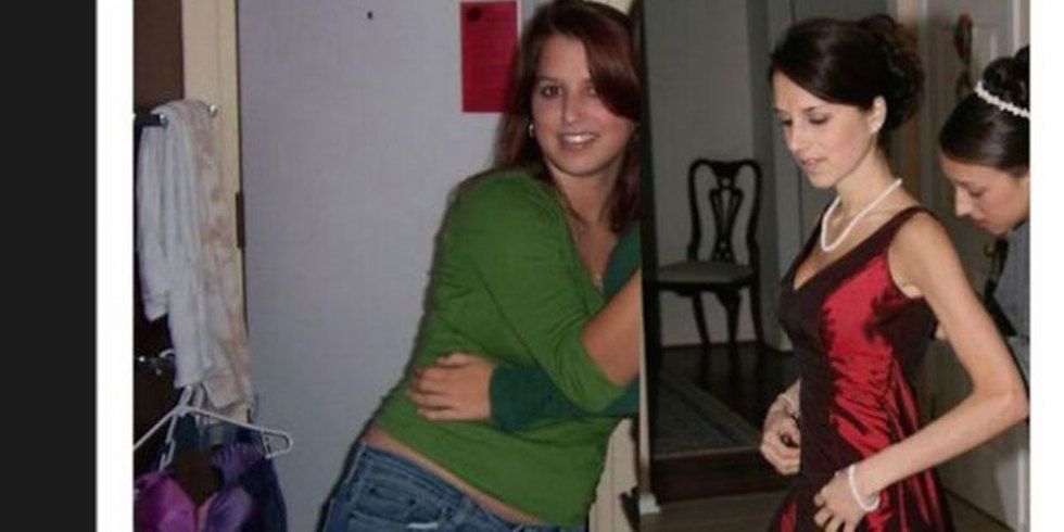 Site Posts Amazing Weight Loss Photos Of Woman Struggling With Anorexia 
