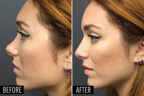 Image of nose plastic surgery
