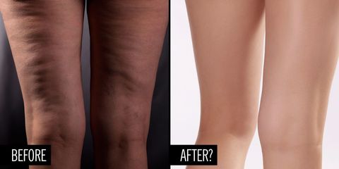 before-after-cellulite-lead