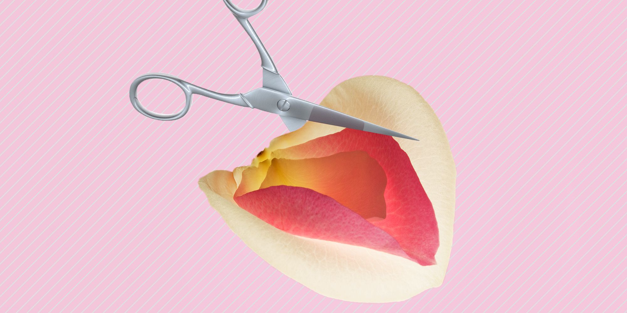 Женские малые половые губы. Лабиопластика Эстетика. Пластика малых половых губ (лабиопластика. Что такое лабиопластика в гинекологии.