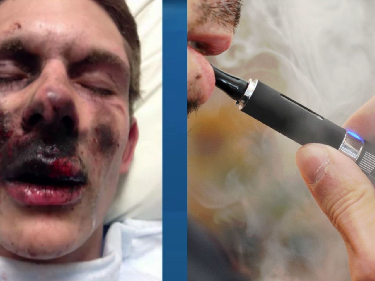 A Teen s E Cig Exploded on His Face and the Photos Are Extremely