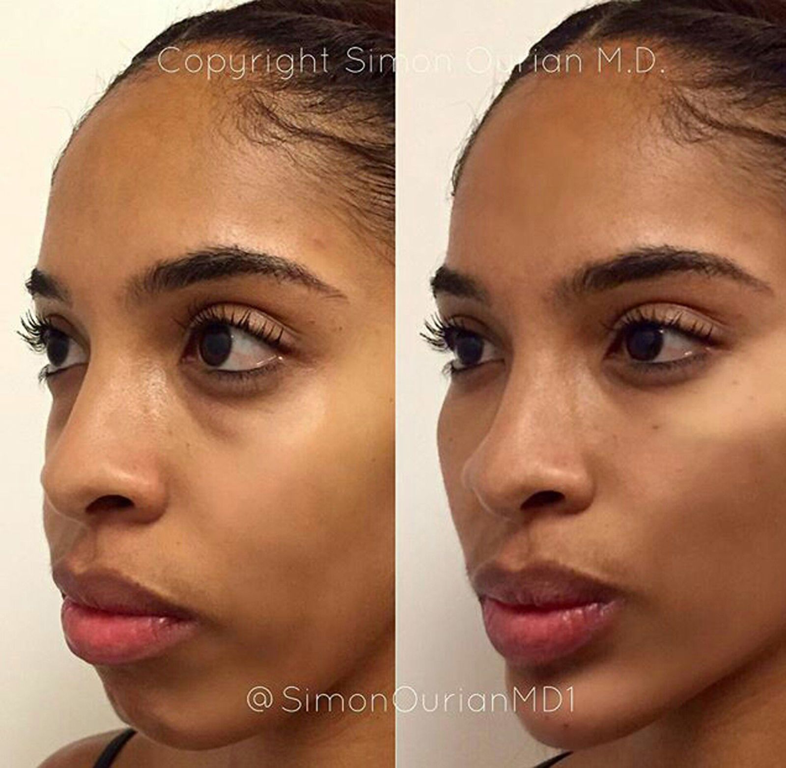 permanent fillers