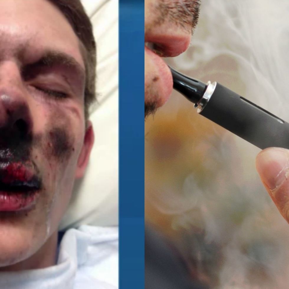 A Teen s E Cig Exploded on His Face and the Photos Are Extremely