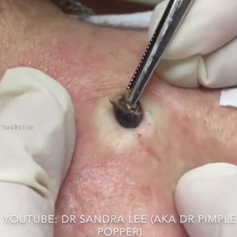 Dr pimple store popper acne