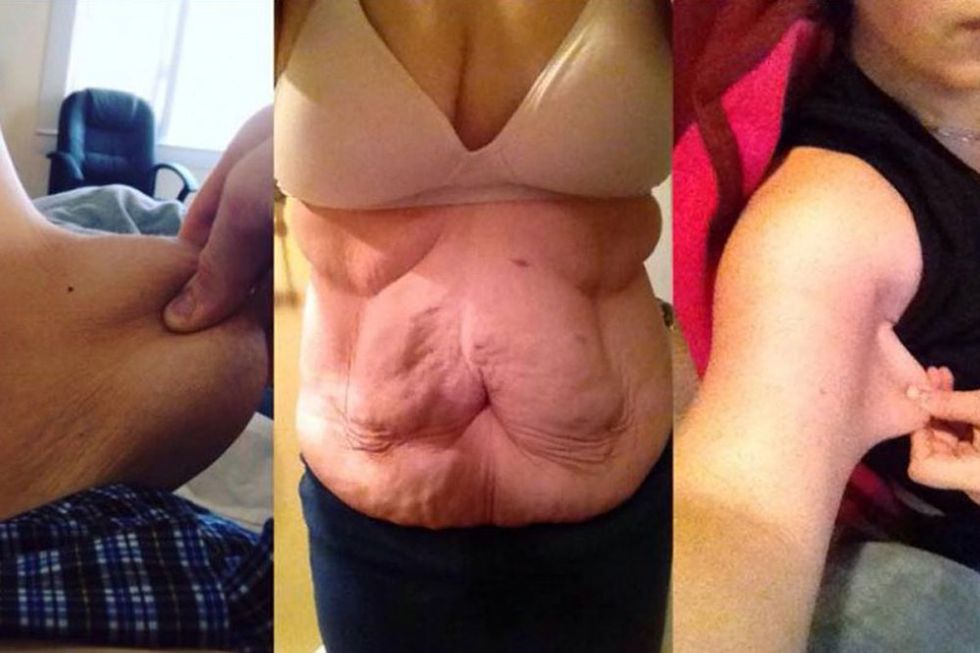 Mum left with horrific scars and deformed tummy 'after weight-loss