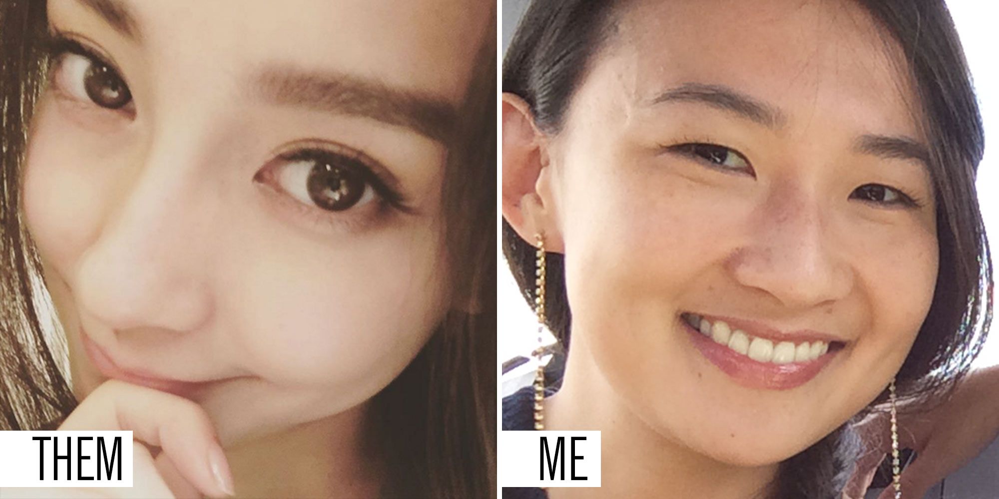 nose job before and after asian