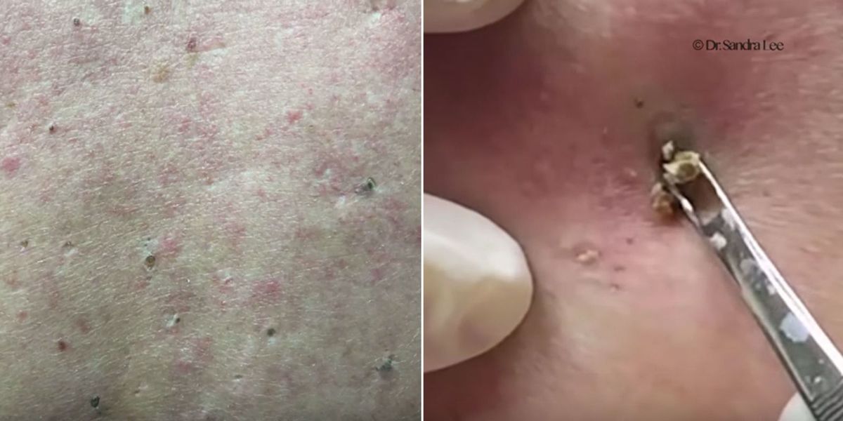 Watch Dr Pimple Popper Go To Town On This Minefield Of Back Blackheads Whats The Best Way To