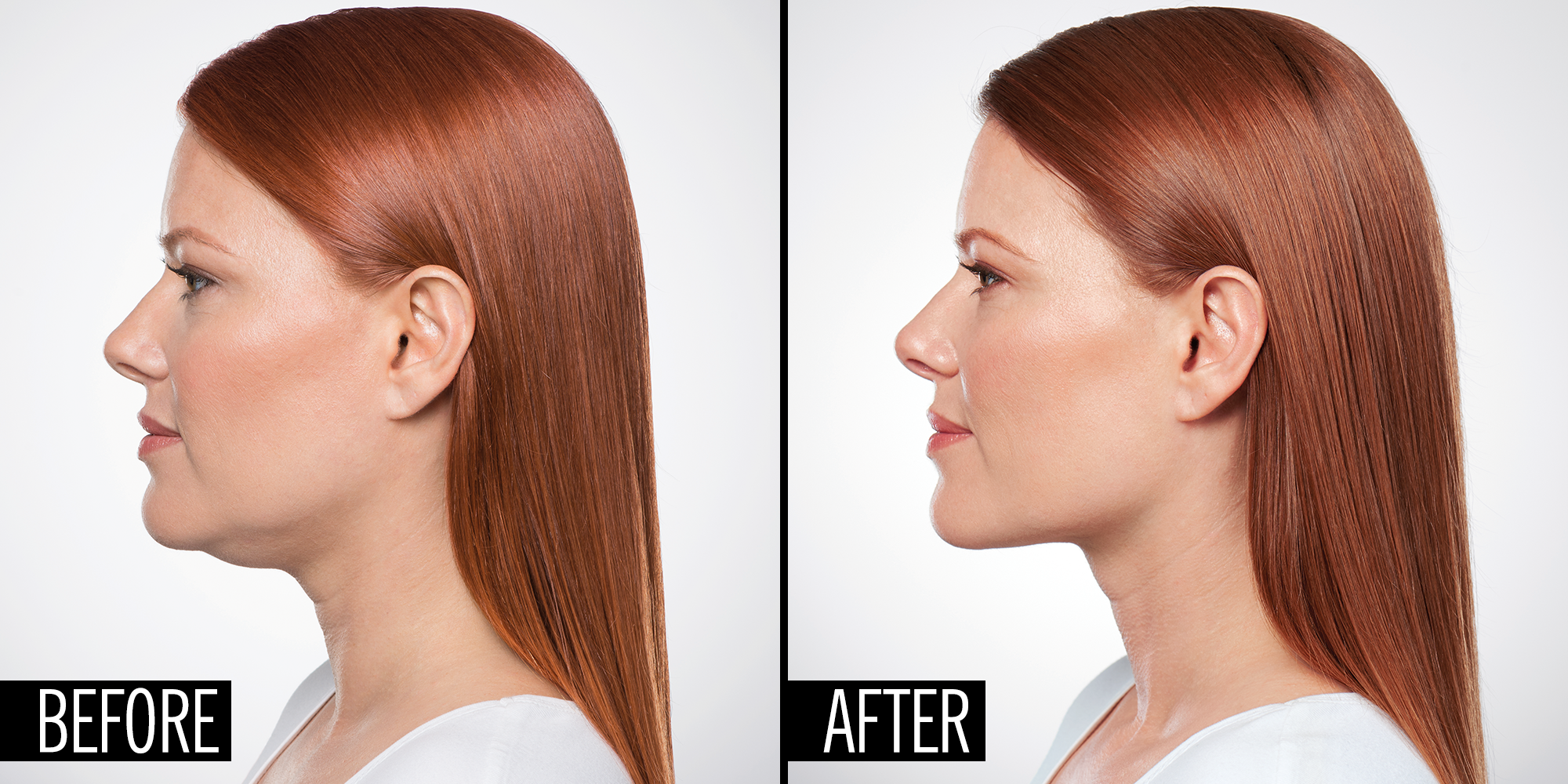 how a plastic surgeon can eliminate your double chin with an