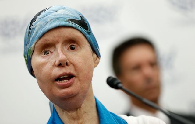 Charla Nash Chimpanzee Attack Victim Hospitalized Face Transplant