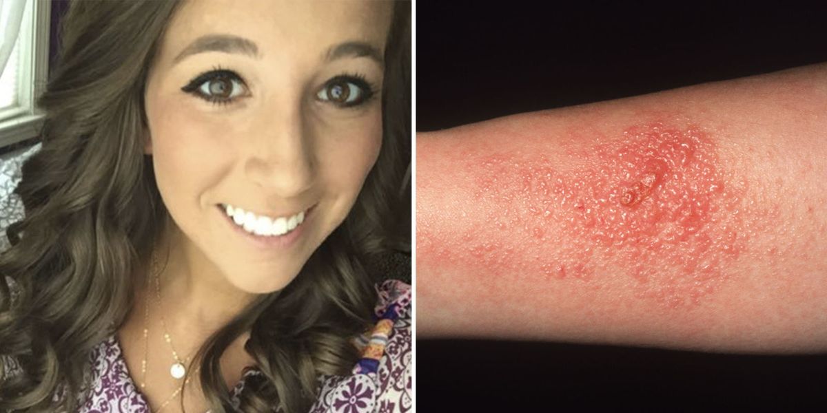 You Have To See What Happened When This Girl Got Poison Ivy In Her Eyes 