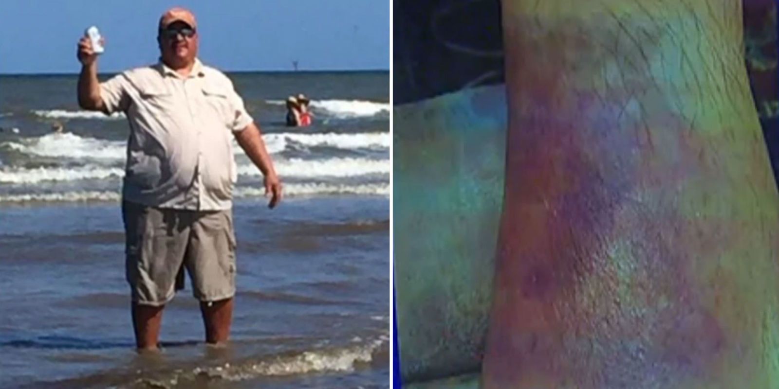 Man Releases Graphic Pictures Of The Flesh-Eating Bacteria Consuming ...