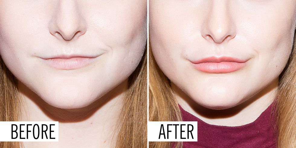 I Got Lip Injections - What It's Really Like to Get Lip Fillers