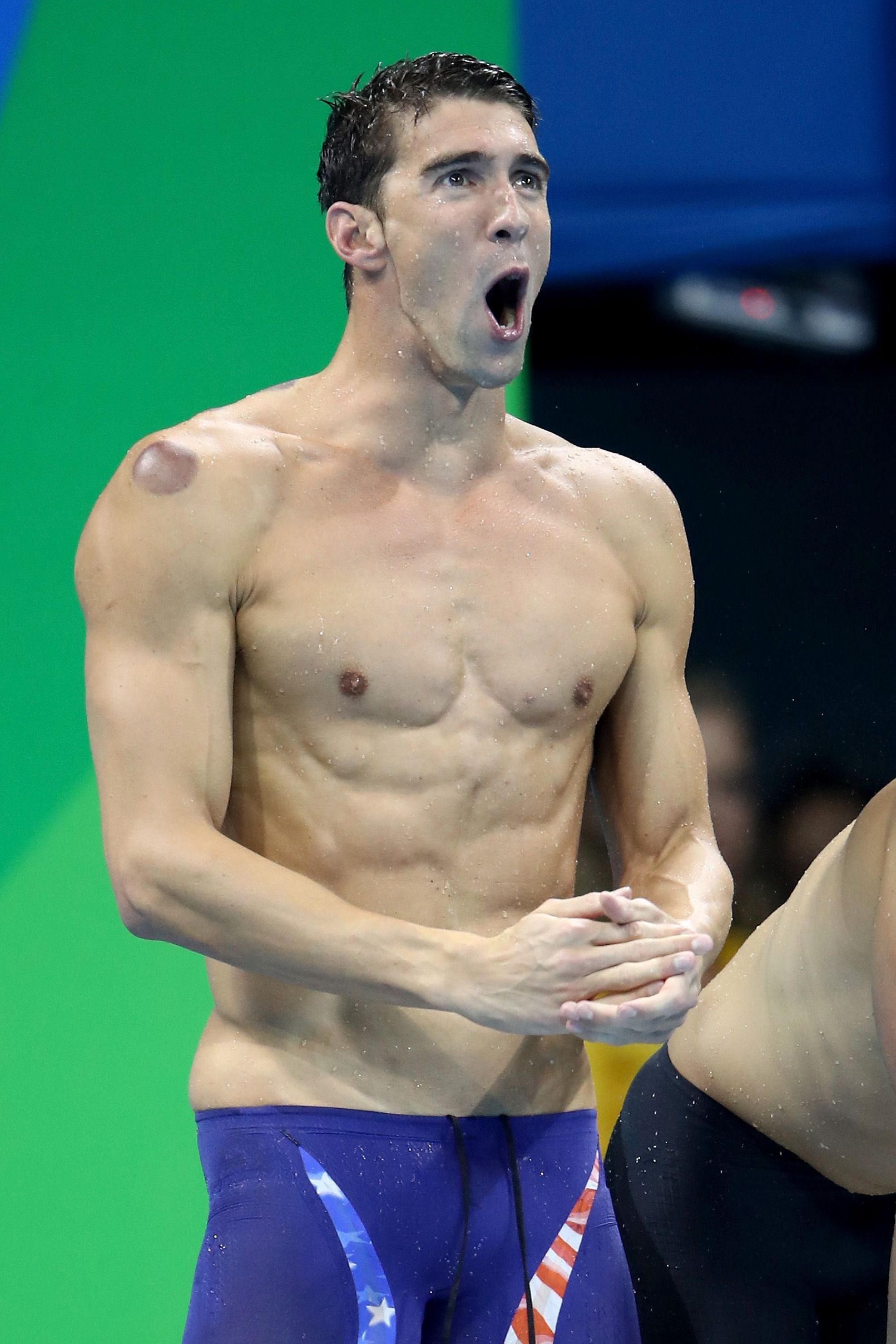 Michael Phelps Has Purple Bruises From Cupping