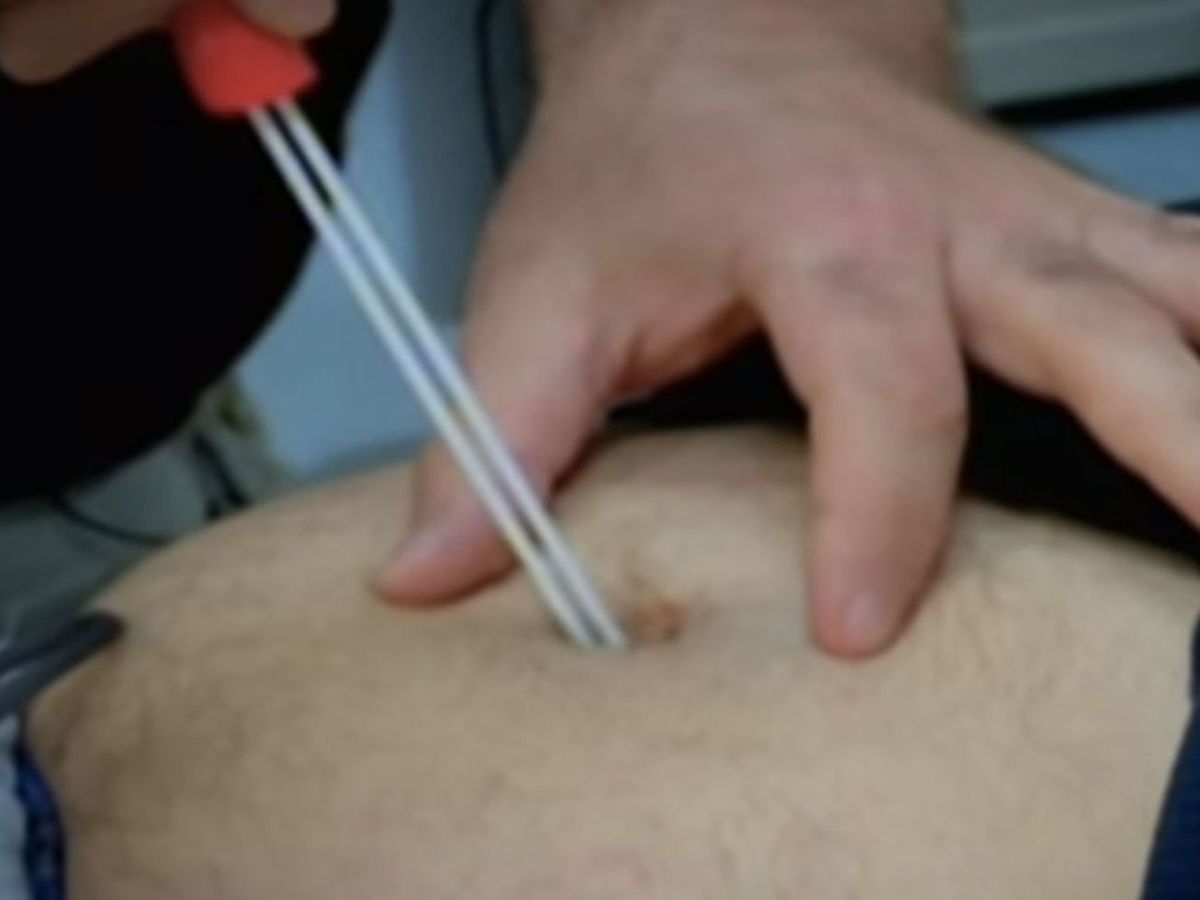 Cyst-Popping Vids Are Old News — Vom-Worthy Belly Button Secretion  Extractions Are So Hot RN