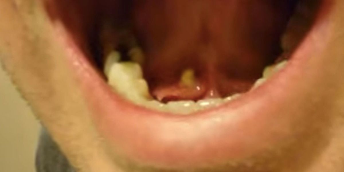 Here Watch A Salivary Stone Get Pooped And Popped Out Of This Mans Tongue