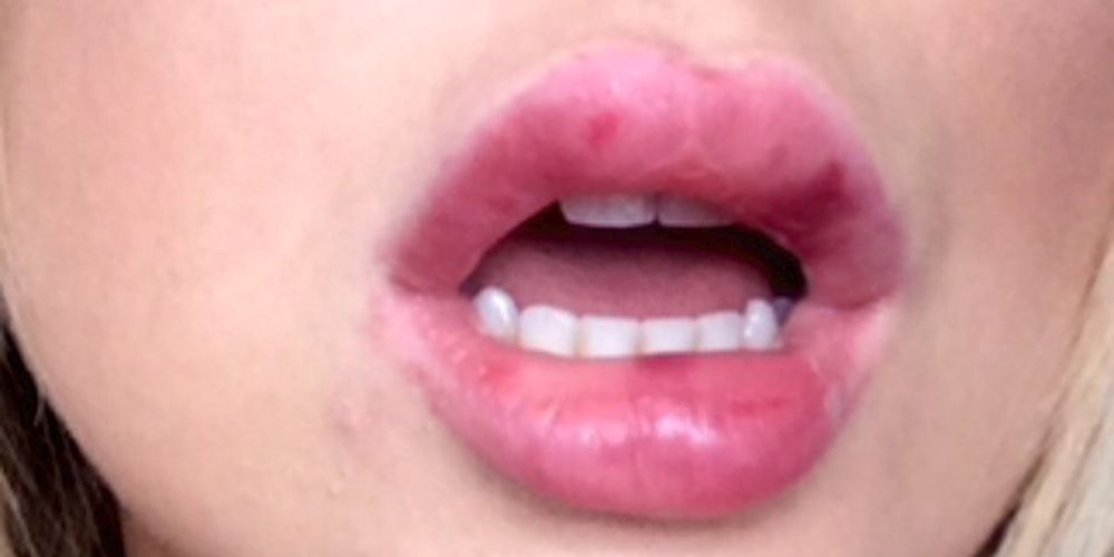 What Does It Mean When Your Lips Go Numb After Kissing