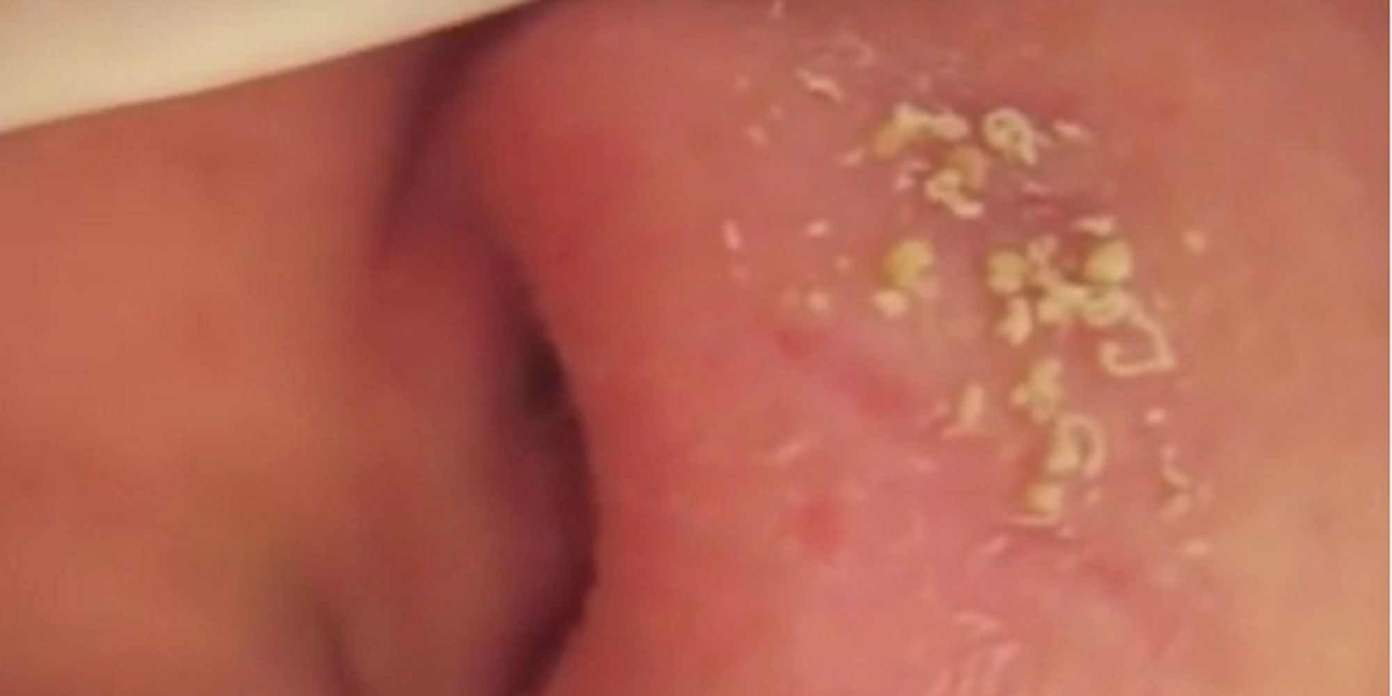 This woman has dozens of blackheads squeezed at the same time