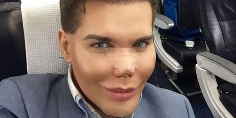 Human Ken Rodrigo Alves suffered from a rotting nose