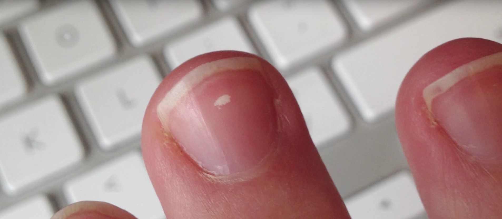 Premium Photo | White spots on finger nails called leukonychia reveal the  emergence of health problems