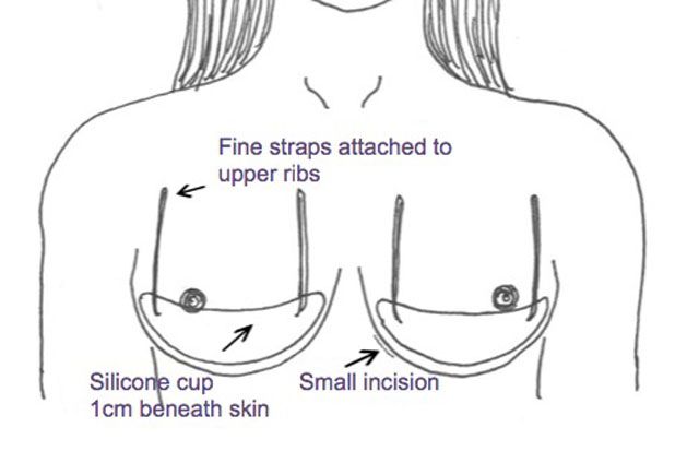 The Internal Bra Technique: What is it and how does it work?