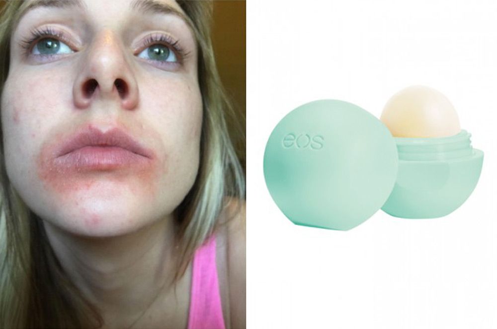 EOS Lawsuit Settled - Lip Balm Company Sued