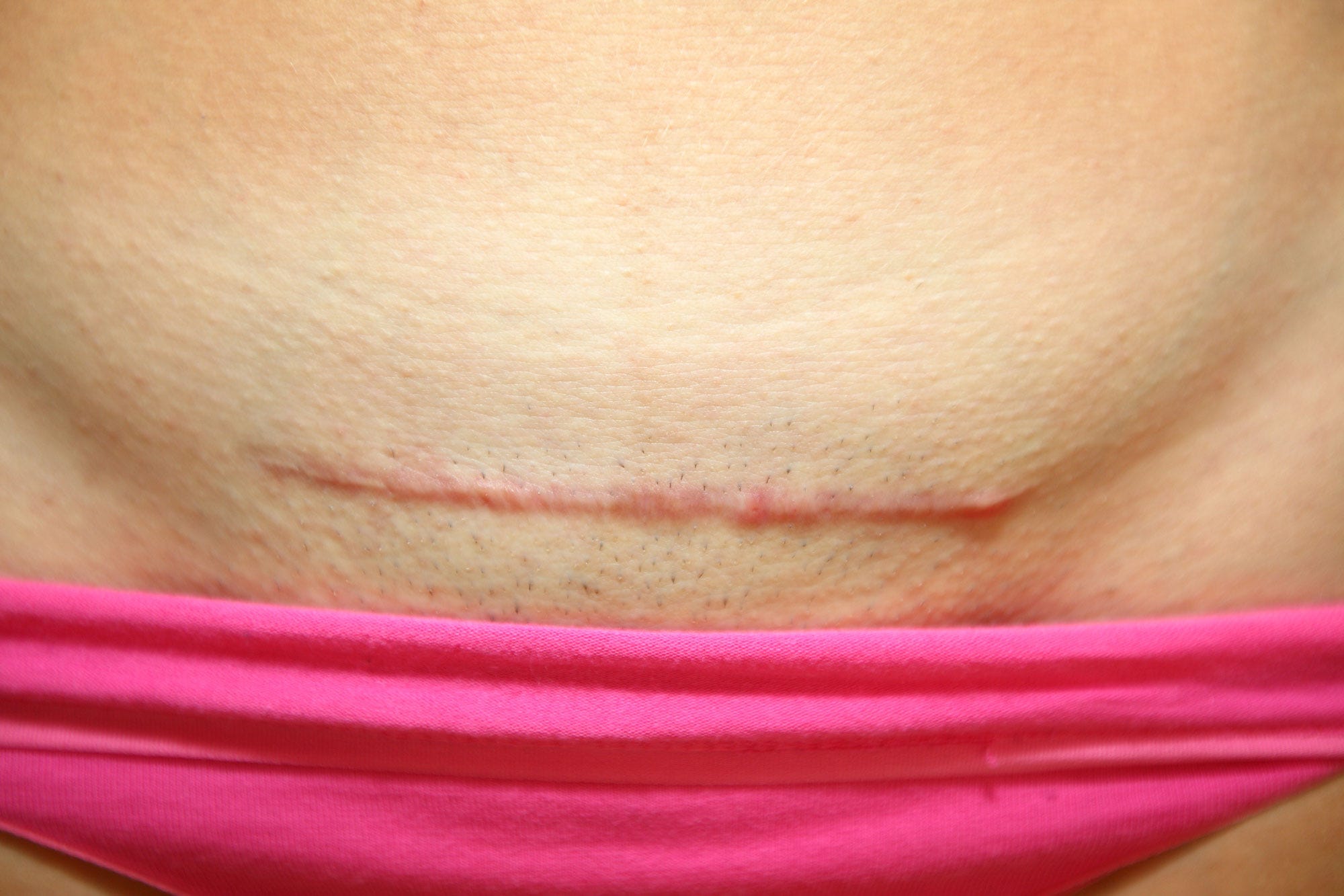 Typical c section scar