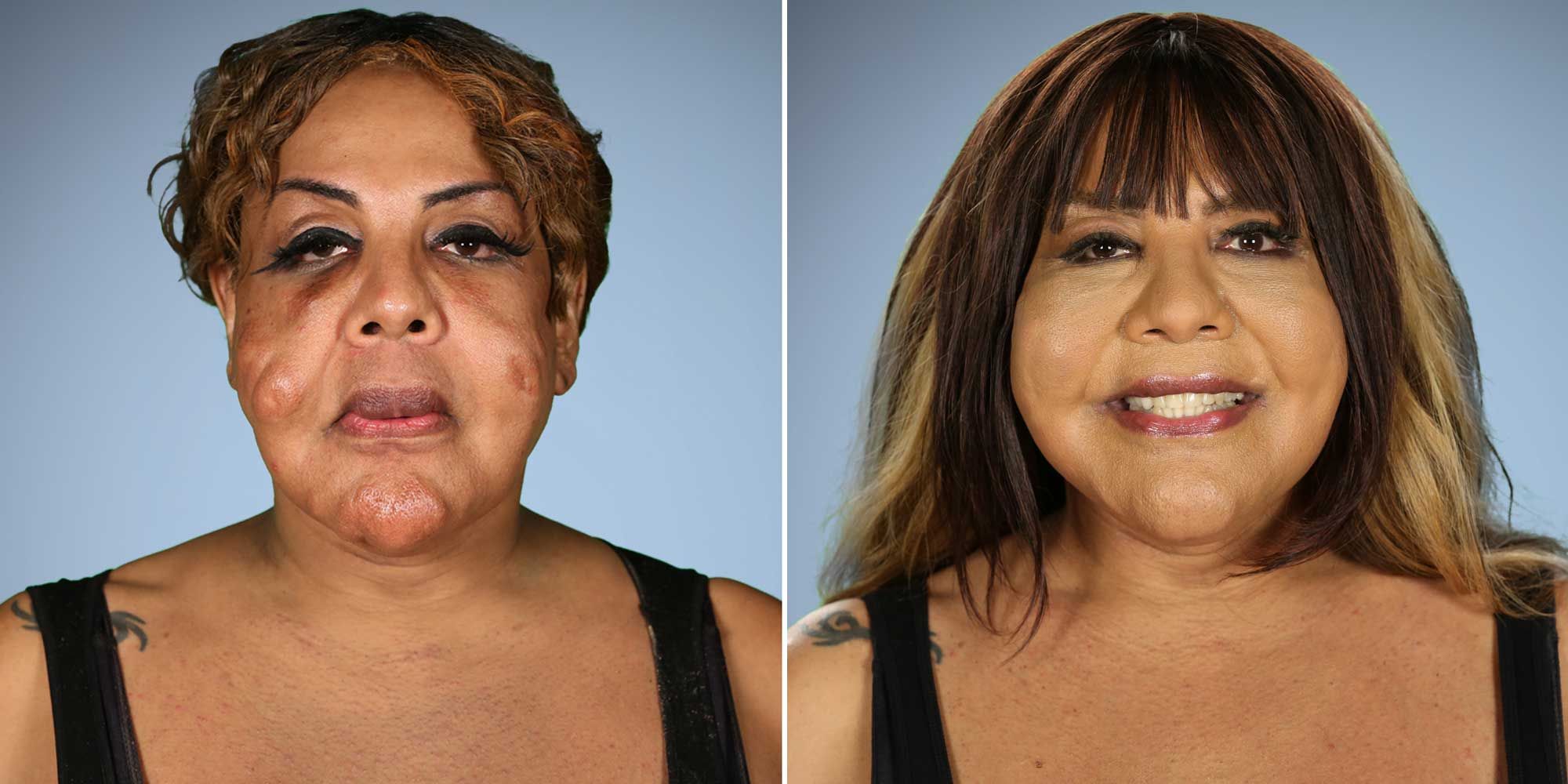 Botched Plastic Surgery