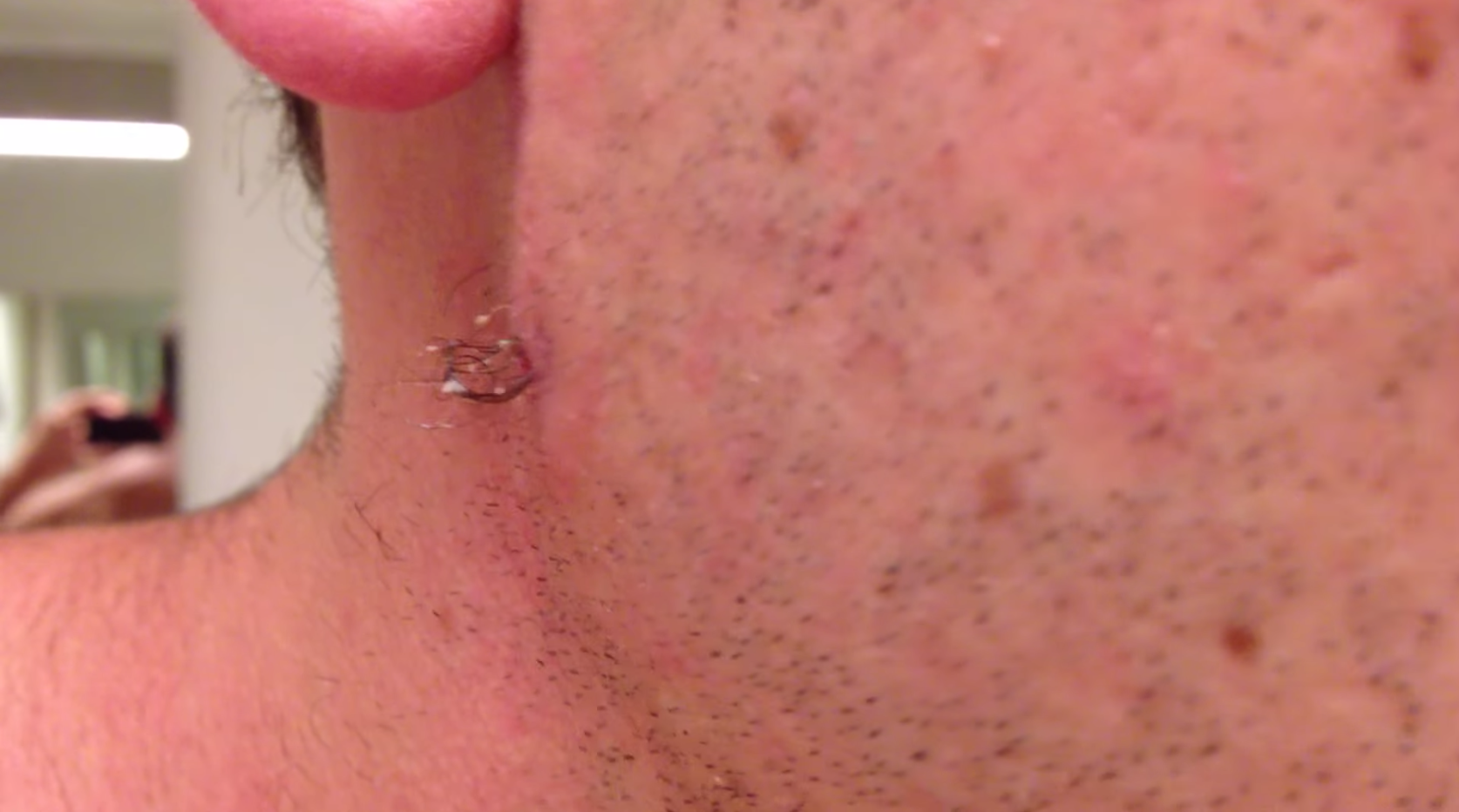Man Pulls Out The Longest Ingrown Hair In The History Of The World