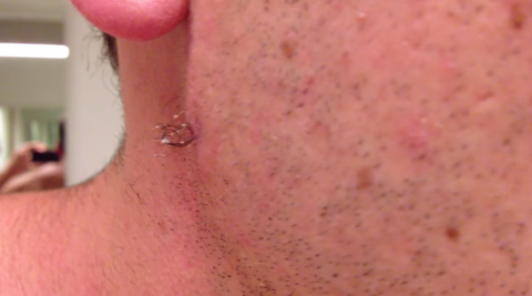 Man pulls out the longest ingrown hair in the history of the world Man pulls out the longest ingrown hair in the history of the world