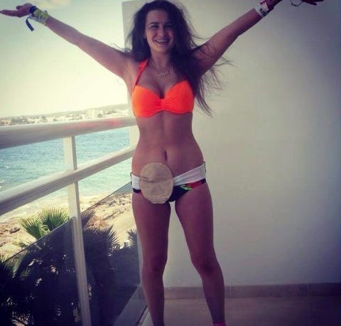 Living With A Colostomy Bag 8 Things I Wish D Known About Life Get Your Belly Out Campaign Colostomy Photo
