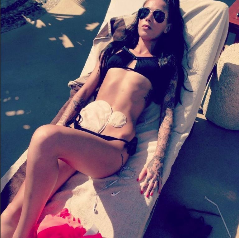 Bethany Townsend Crohns disease colostomy bag bikini selfie