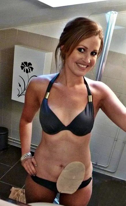 Colostomy Bag Selfies Are The New Inspirational Trend On Social Media 